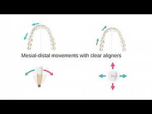 Mesial-distal movements with aligners. My lecture from 2020 - Part 3.