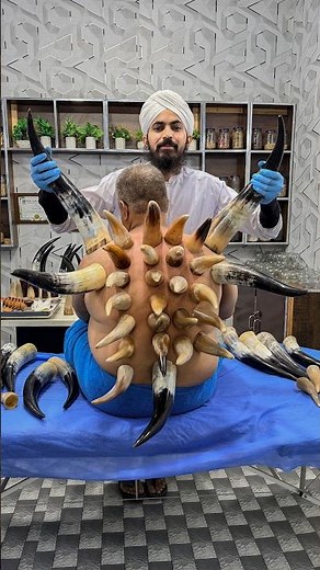 What Is Horn Cupping Therapy | Benefits of This Traditional Alternative Therapy | Dr Usman Faiz