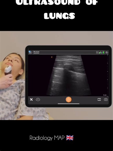 Understanding Lung Ultrasound: A Comprehensive Guide