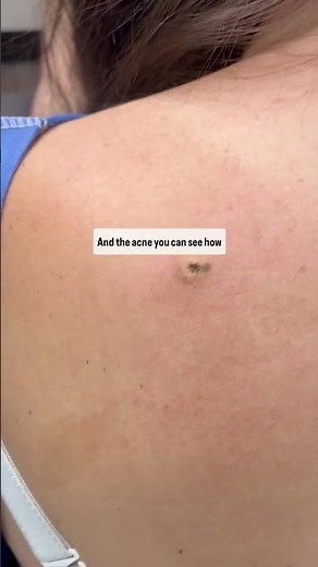 Dermatologist with 50 years experience shows mole removal with hyfrecator 2000 device