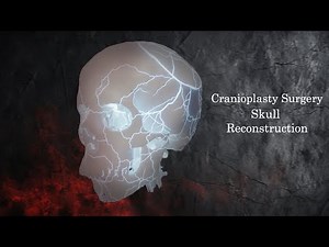 Cranioplasty Surgery Explained in 3D | Skull Reconstruction