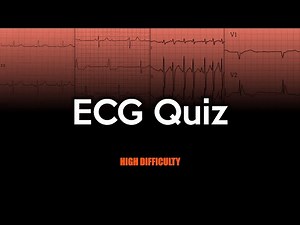 ECG Quiz: High Difficulty