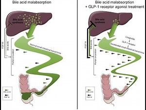 Bile acid malabsorption or bile acid diarrhea ; Definition, Causes, Symptoms, Diagnosis, Treatment