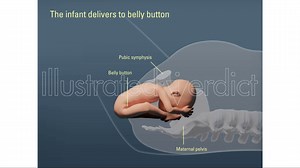 Breech Delivery w/ Forceps