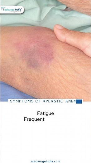 Aplastic Anemia Treatment ,Causes ,Symptoms & Diagnosis