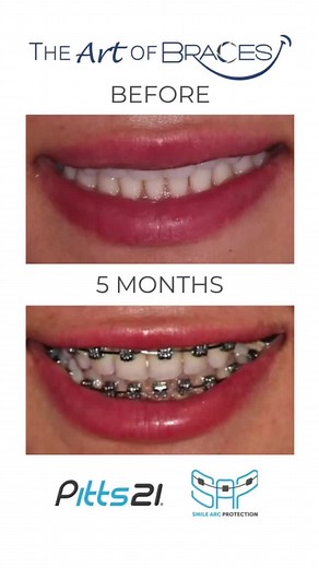 The Art of Braces on TikTok