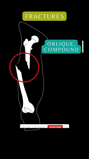 Fractures #longbones #medicine #medstudent #nursing #nursingstudent #anatomy #anatomia #bones #orthopedics #fractures #brokenbones #fyp #skeleton #med