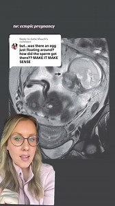 49K views · 368 reactions | how do ectopic pregnancies happen? #ectopicpregnancy #abdominalpregnancy #ectopicpregnancyloss | Paging Dr. Fran | Facebook