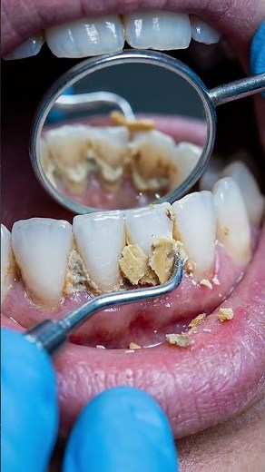 How to Remove Plaque and Tartar Completely | Satisfying Teeth Cleaning Transformation 🦷✨