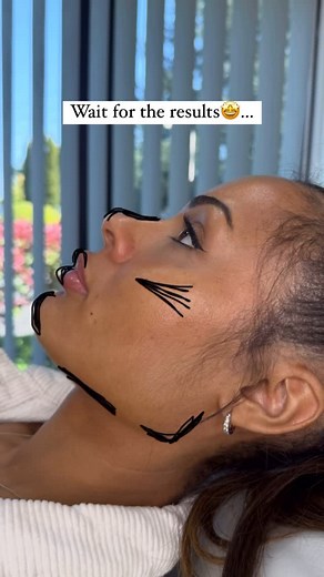 Abi Farrow + Team of Aesthetic Experts on Instagram: "Want to learn how to sculpt a side profile that still looks like them - just more refined? 💬 Comment “SYSTEM” below to get access to the full dermal filler training bundle 👇 Here’s the truth most injectors were never taught: It’s not about how much filler you use… it’s about where and why you place it! This stunning transformation was created using strategic, minimal product to deliver maximum impact - and inside our Online Dermal Filler Ma