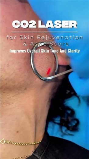 Transform Your Skin with CO2 Laser Treatment