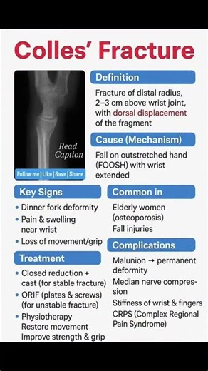 Colles fracture #bams #science #mbbs #physiotherapy #motivation #education