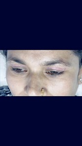 4.3K views · 52 reactions | Facial House Fibroblast Skin Tightening: A Non-Surgical Treatment Booking number ☎️9841135172 | Facial House | Facebook