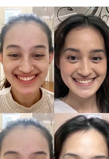 Pengalaman Behel dengan drg Evie: Perjalanan 2.5 Tahun