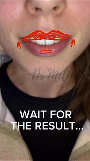 ✨ A Little Lip filler, A Lot of Confidence ✨ This beautiful patient was already naturally stunning — her eyes, her smile, her features were gorgeous just as they were. 💋✨ But she wanted a little boost in confidence and felt her top lip was much thinner compared to her bottom lip. So we added some filler, focusing on the top lip, bringing her lips into soft, natural proportion. No overfilling. No changing who she is. Just enhancing what she already had. ❤️ The result? A balanced, harmonious lip