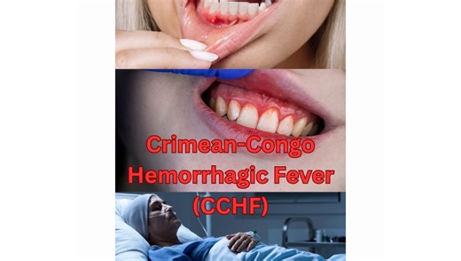 • Crimean-Congo Hemorrhagic Fever (CCHF) : symptoms , Transmission , Treatment and prevention •Check out the new video♥️ •Watch the full video on our youtube channel👇 #medforu96 #subscribeouryoutubechannel 🛎️ Welcome to our in-depth video on Crimean-Congo Hemorrhagic Fever (CCHF). In this educational video, we cover everything you need to know about CCHF, including its clinical manifestations, transmission routes, diagnostic methods, treatment options, and preventive measures. Stay informed an