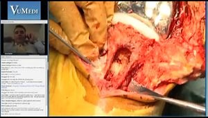 Transplanting the Extensor Mechanism: When All Else Fails in Revision TKA