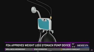 Weight loss stomach pump device approved by FDA