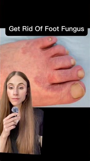 How to Get Rid of Foot Fungus #dermatologistadvice