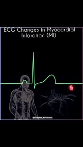 13K views · 920 reactions | 變MI ECG Timeline: Acute ST elevation (hrs), pathological Q waves (12h), T wave inversion (days-wks), chronic Q wave persistence (mos-yrs). ST normalizes by 1 mo, T waves by 1 yr. See the progression! #Cardiology #ECG #MyocardialInfarction #CardioEd | Abdallah Othman | Facebook