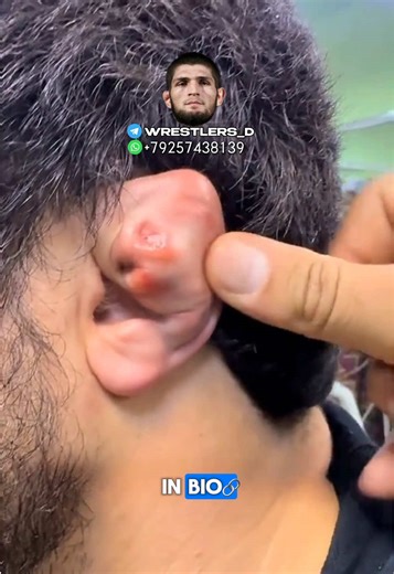 Cauliflower Ear Tutorial: How to Manage and Prevent