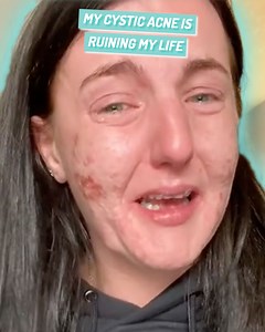 I’ve tried to get rid of a big cyst on my face - professionals say it’s the worst they've ever seen 😭 | Ultimate