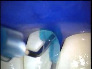 Bioclear - Peg Lateral