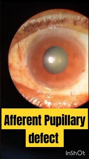 Afferent Pupillary Defect || #APD #pupilteacher #eyediseases