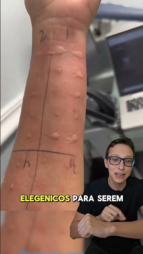 Teste de Alergia 😱#medicina #medico #enfermagem #enfermeiro #alergia #alergias #saude prick test