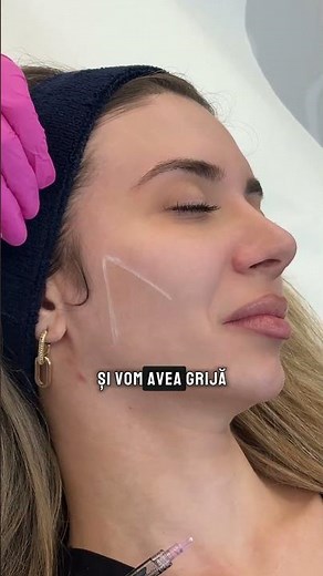 Refacerea țesuturilor adipoase faciale cu Profhilo Structura