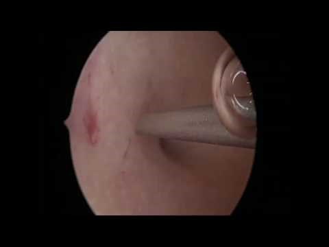 NovaSure Procedure in an Outpatient Setting utilising the fundal block anaesthetic technique