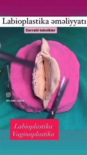 From dr Gunel-Azizova Labioplasti surgery عملية قص الشفرات تحت التخدير الموضعي ✨
