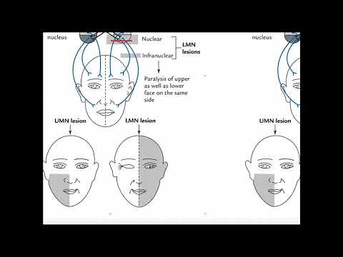 Mechanism of Facial (Bell's) Palsy and Clinical Interpretation