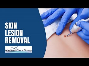 Skin Lesion Removal | Northland Plastic Surgery