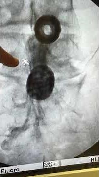 Scar tissue after a lumbar fusion operation