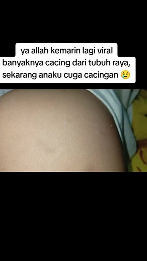 Mengatasi Cacingan pada Anak dengan Obat Cacing