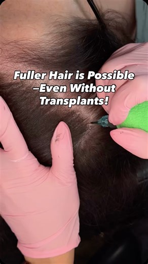 ✨ Empowering Women Through SMP ✨ Hair thinning or hair loss can affect women just as much as men, but it’s often overlooked. Female SMP (Scalp Micropigmentation) is a revolutionary solution that gives women the confidence to feel like themselves again. 💖 What is Female SMP? It’s a non-invasive, long-lasting cosmetic procedure that uses tiny, natural-looking pigment deposits to recreate the appearance of fuller hair. Perfect for thinning hair, alopecia, or even to add density after hair transpla