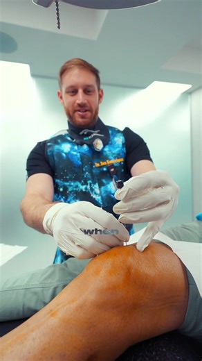 How to alleviate knee pain? Genicular nerve blocks act as a roadmap before radiofrequency ablation. By temporarily numbing specific nerves around your knee and monitoring your response, we confirm which nerves are responsible for your pain. Positive results from the block predict excellent outcomes from RFA, which provides much longer-lasting relief by treating those same nerves. It’s strategic treatment—test first with the block, then proceed to RFA for extended pain control. #painrelief #kneep