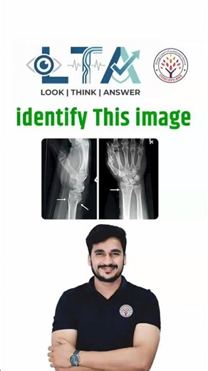 Identify The Fracture🤔#fracture #nursing #norcet11 #nursingmcq #sgpgistaffnurse #nursingexamprep