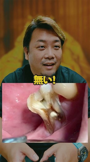 Treatment for a tooth that's split open!? [Dentist]