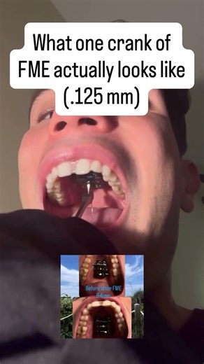 What one crank of FME actually looks like