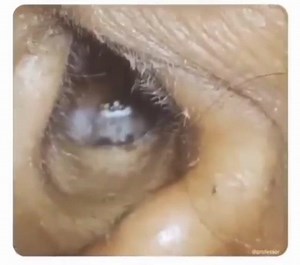 Extraction d'un corps étranger intra- auriculaire | La Bibliothèque Médico-chirurgicale