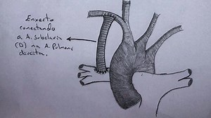 Shunt Blalock-Taussig clássico vs. modificado: indicações, vantagens e
