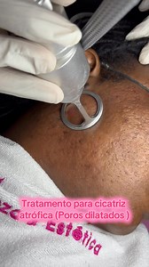 O tratamento de cicatrizes atróficas com Laser de CO2 Fracionado é uma das abordagens mais eficazes na dermatologia estética. Esse tipo de cicatriz, comum após acne severa ou catapora, é caracterizado por depressões na pele devido à perda de colágeno. Como o Laser de CO2 Fracionado funciona: • Ação térmica e ablativa: o laser emite feixes de luz que criam microcolunas de dano controlado na pele, atingindo camadas profundas. • Estimulação de colágeno: esse dano estimula a produção de novo colágen