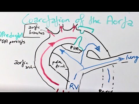 Coarctation of the Aorta: Presentation, Pathophysiology, Diagnosis & Treatment