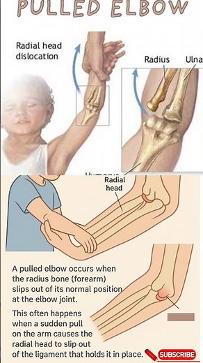 Reduction of a pulled elbow#anatomy#elbow#ortho#emergencymedicine#aiimsdelhi#hospital#doctor#shorts