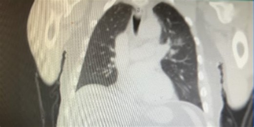 Health Check: Lung cancer screenings, and how W. Va. residents can qualify for a National Lung Cancer Screening program