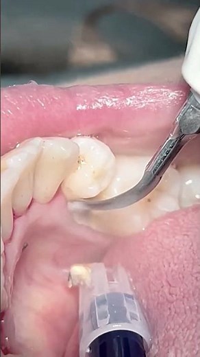 Scaling teeth tartar & calculus #dentist #dental #satisfying