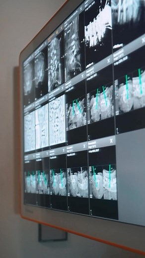 La innovación del TAC robotizado intraoperatorio LOOP-X de Brainlab redefine la precisión quirúrgica, permitiendo la colocación de tornillos pediculares con una exactitud que supera las técnicas tradicionales. Navegamos implantes e instrumentos en imágenes 2D, exámenes 3D o conjuntos de imágenes de TC o RM en cualquier fase de la intervención. 👉BENEFICIOS Planificación Exacta: Facilita la planificación precisa de incisiones y trayectorias con cualquier instrumento. Colocación Precisa: Permite l
