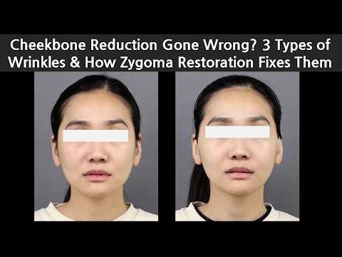 Cheekbone Reduction Gone Wrong? 3 Types of Wrinkles & How Zygoma Restoration Fixes Them